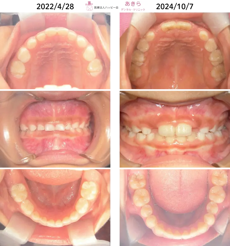 予防的矯正治療-003-001