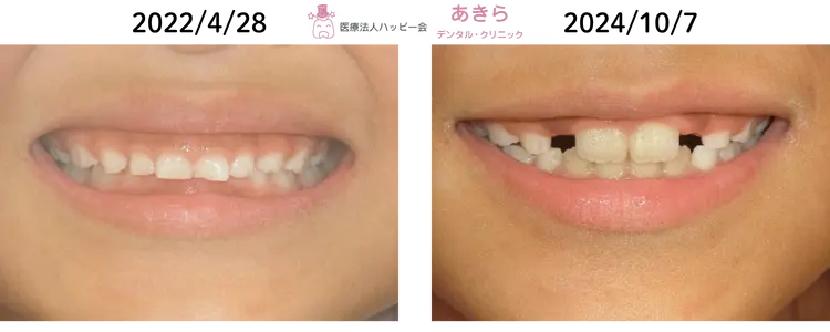 予防的矯正治療-003-002