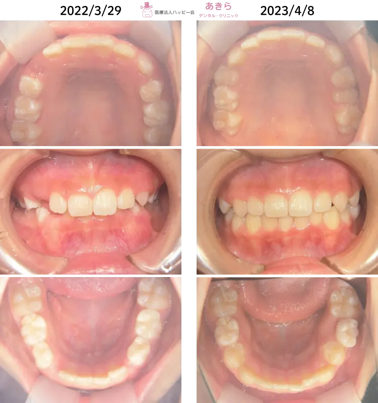 予防的矯正治療-004