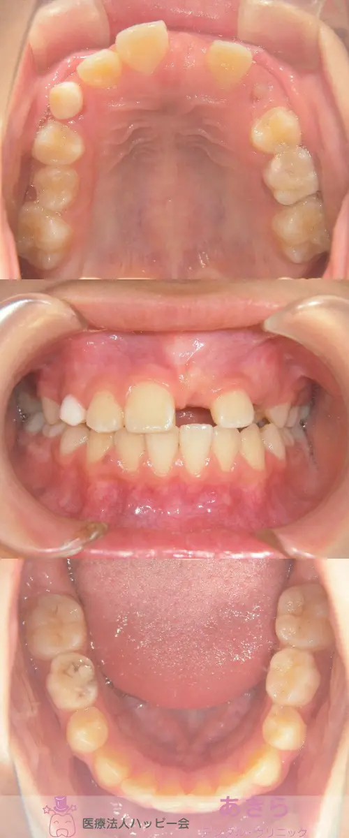 2019年4月6日 初診時口腔内写真