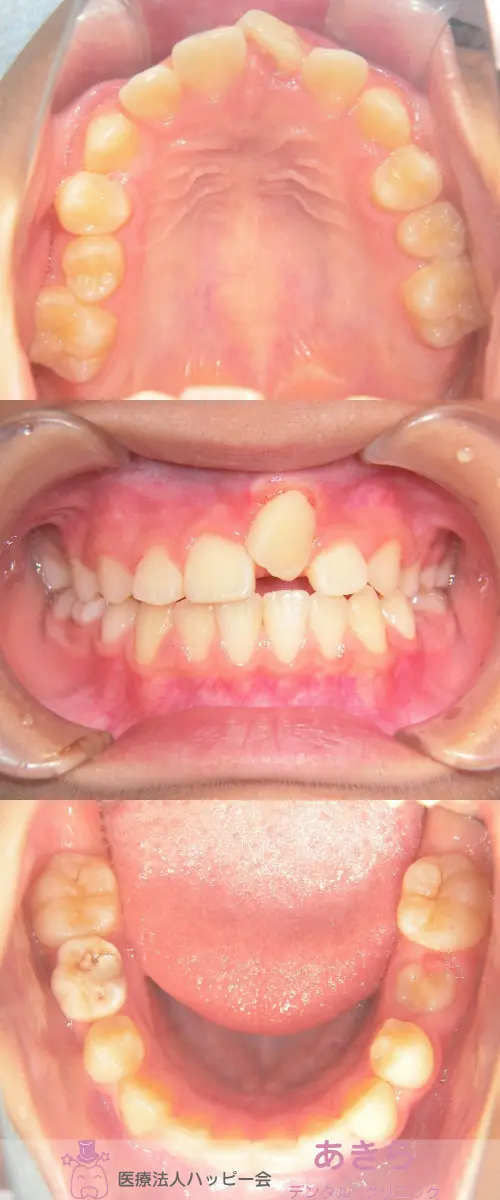 2019年10月6日 口腔内写真