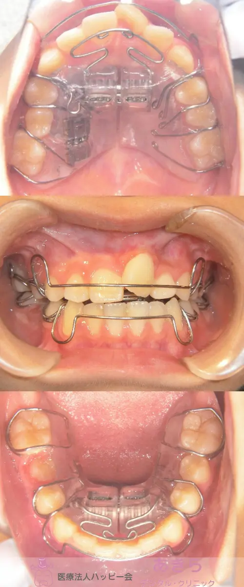 2019年11月29日 口腔内写真(SH装置スタート)