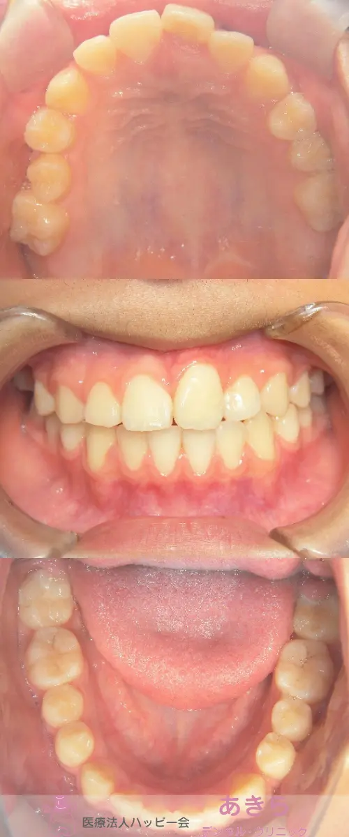 2021年5月8日 口腔内写真(経過時)