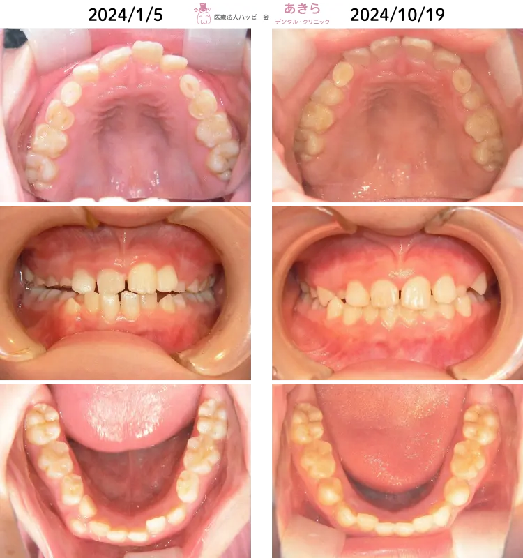 山形市の歯医者あきらデンタル・クリニック-予防的矯正治療-0004