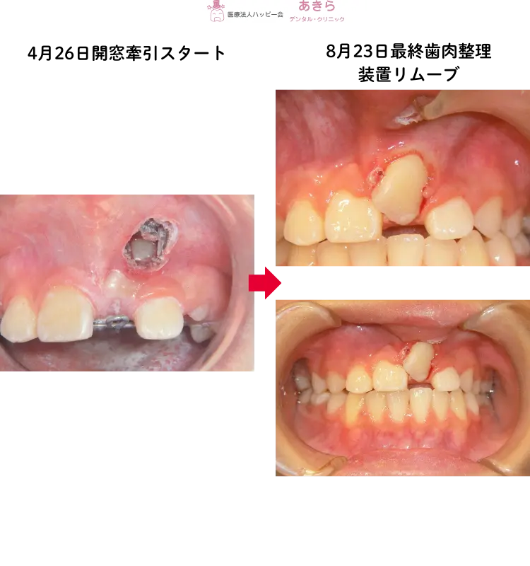 ※経過…┗1番開窓&牽引(2019年)