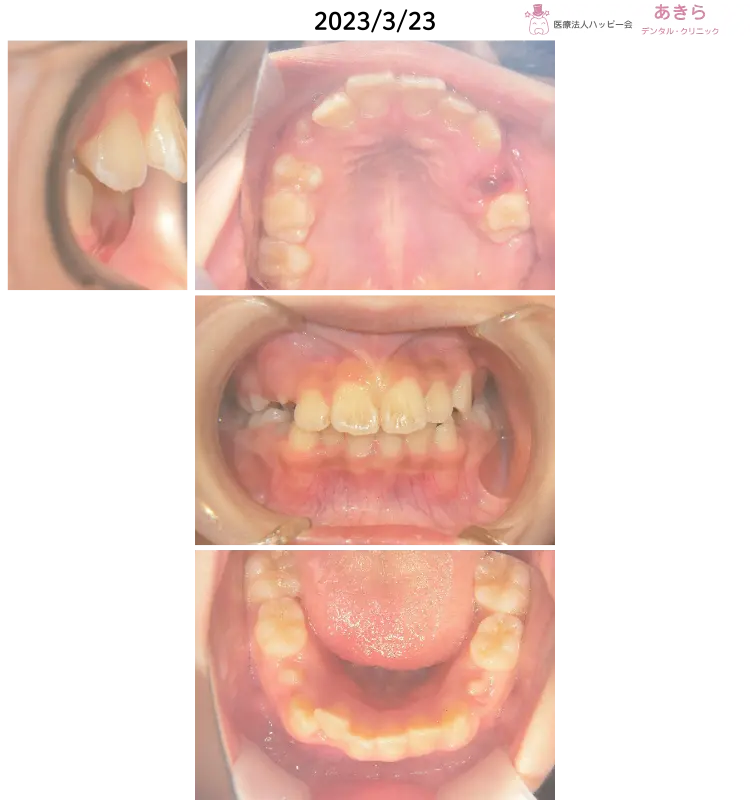 2023年2月13日 初診時 ⇒ 8月21日 SHAスタート時