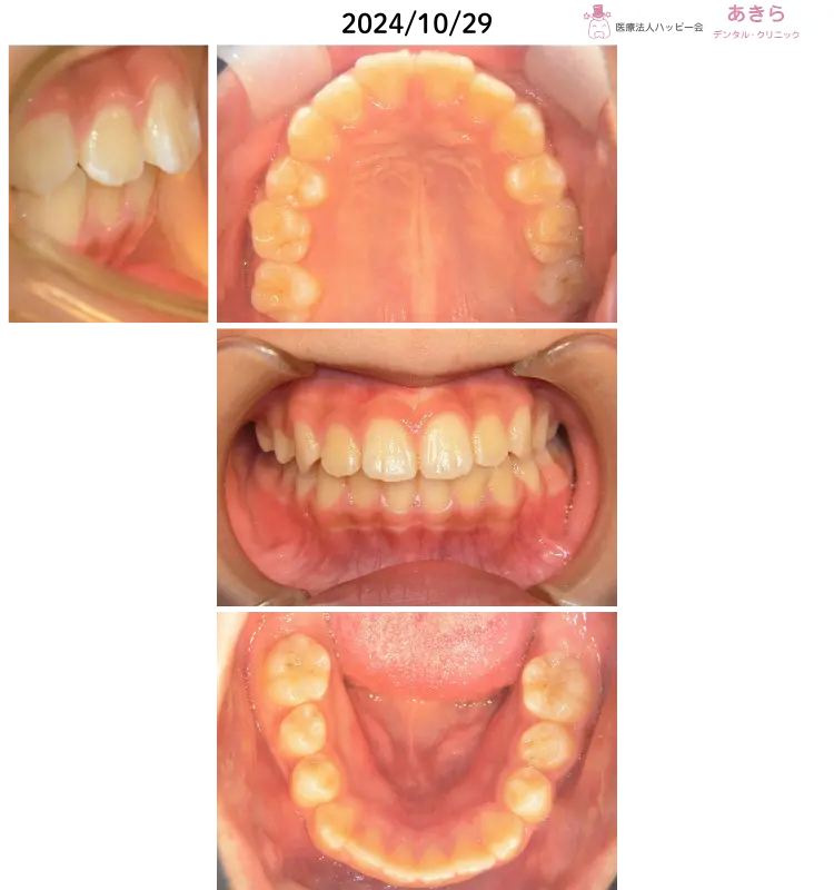 2023年2月13日 初診 ⇒ 2024年10月21日 経過時