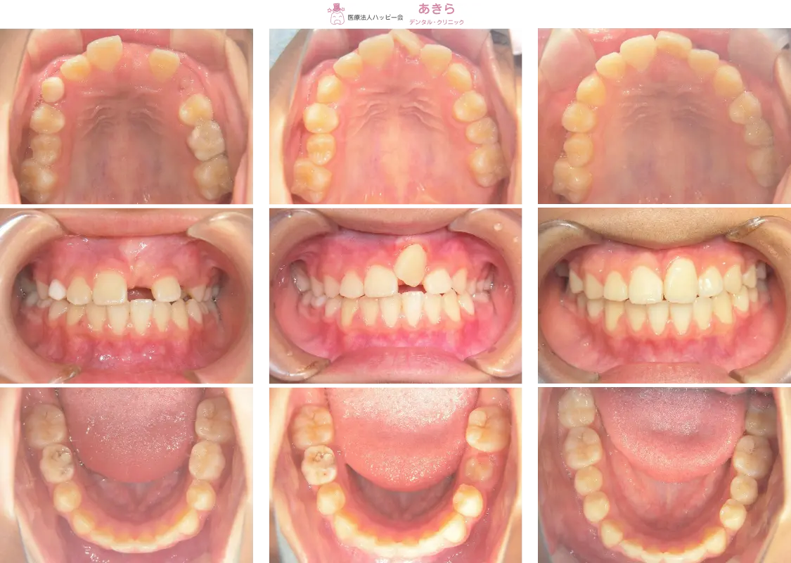 2019年4月9日 初診時 ⇒ 2021年5月8日 口腔内写真(経過時)