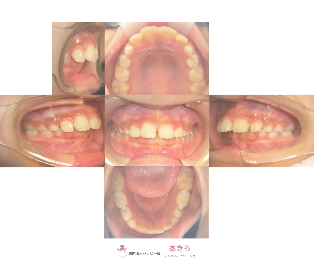 2023年4月12日 初診時口腔内写真(2023年5月 ハビットコレクターセット)