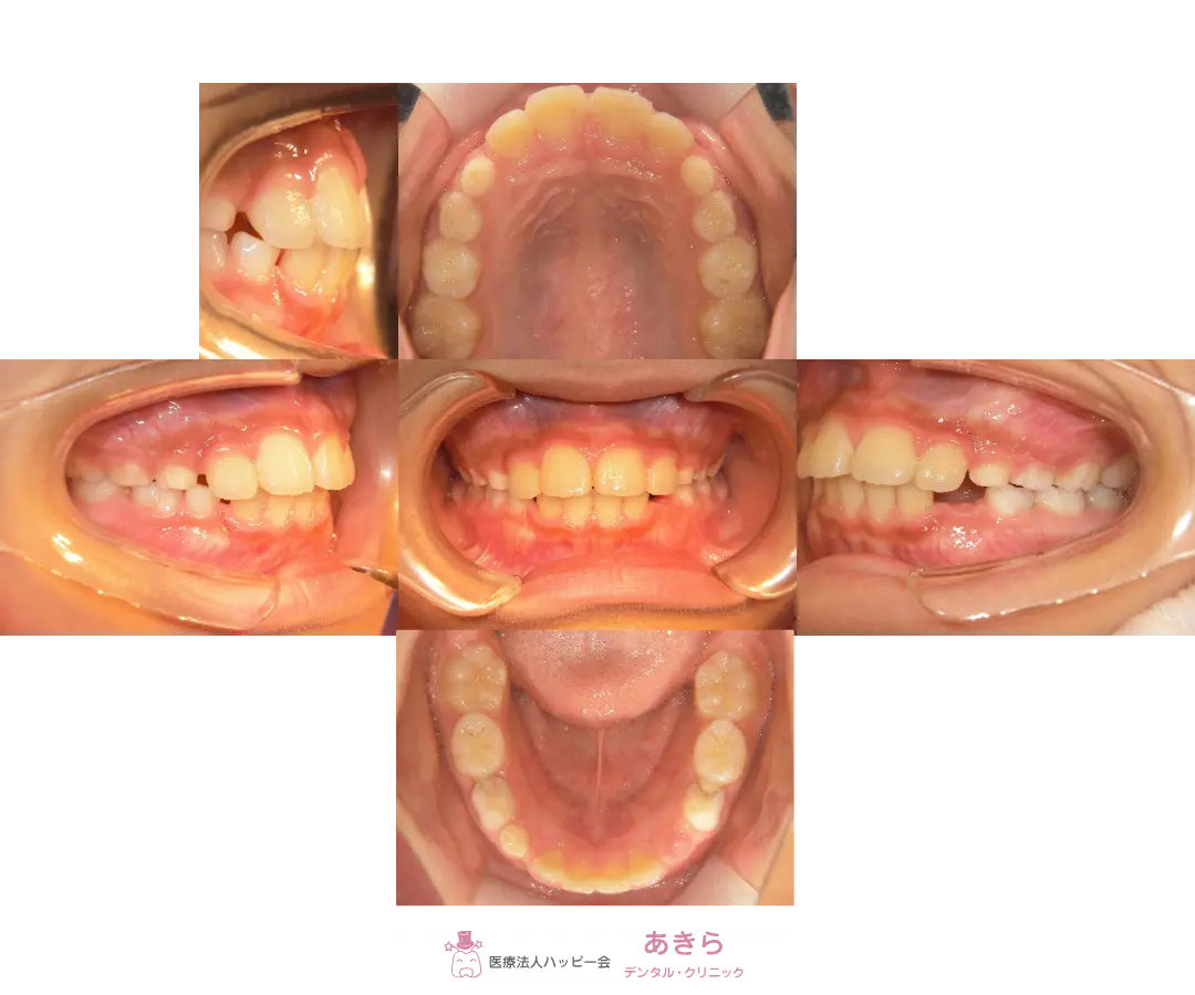 2023年4月12日 経過 口腔内写真