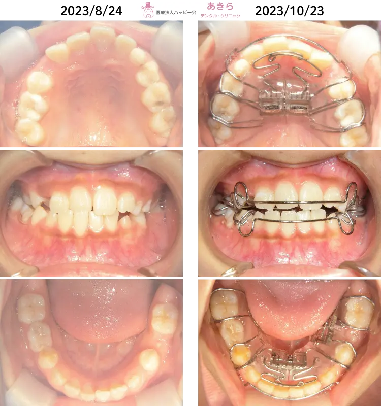 2023年8月24日　初診時口腔内 ⇒ 10月23日　SHAスタート時