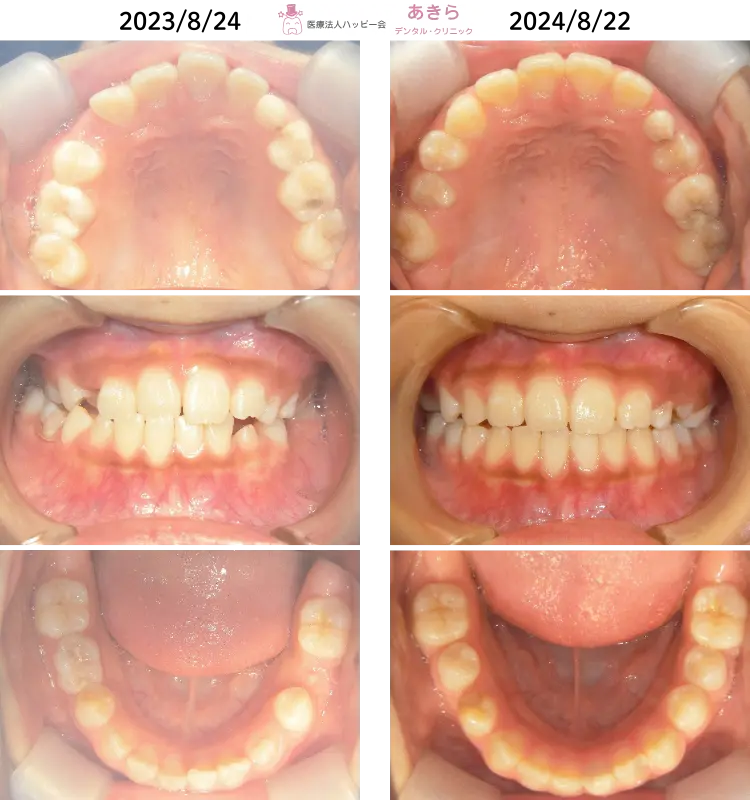 2023年8月24日　初診時 ⇒ 2024年8月22日　経過時