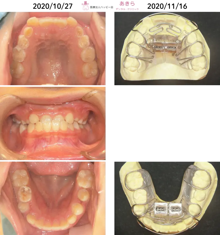 2020年10月27日 初診時 ⇒ 11月16日 SHAスタート時