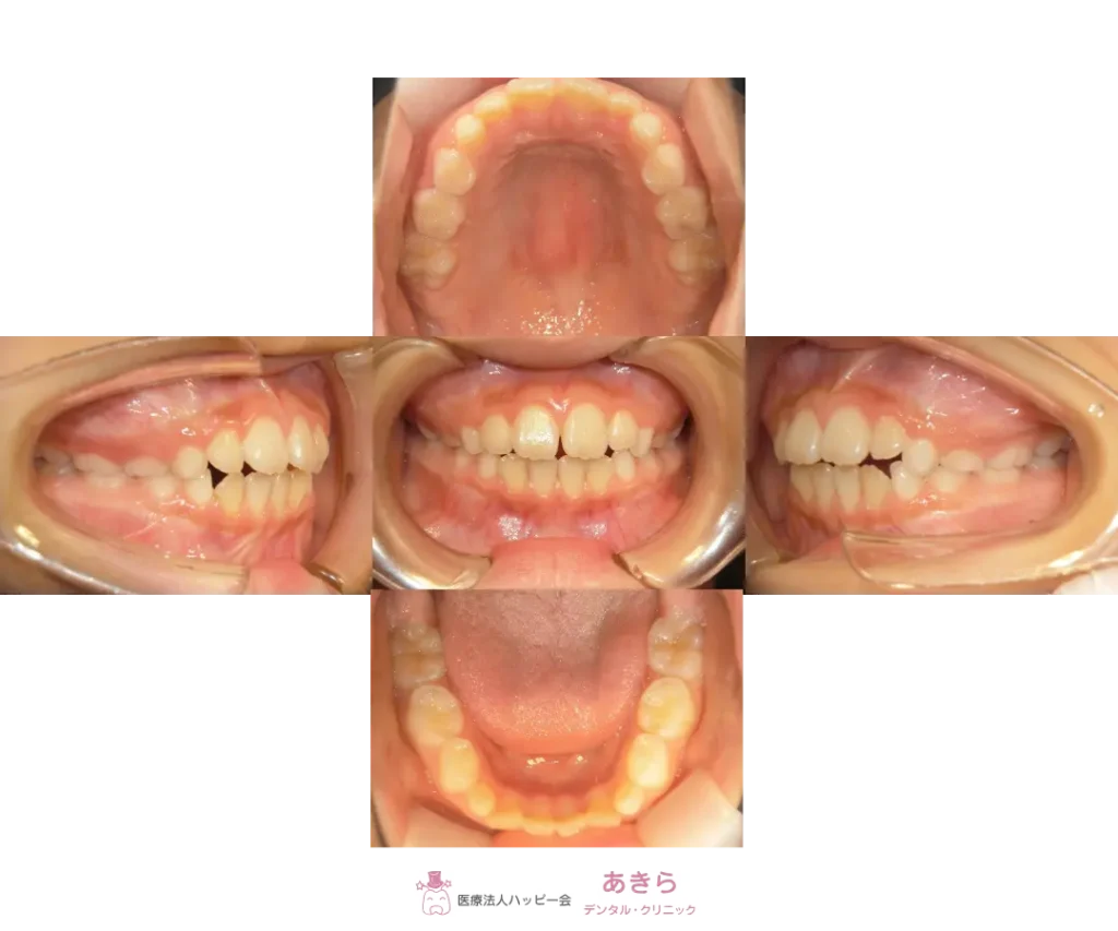 2024年10月28日　経過口腔内写真