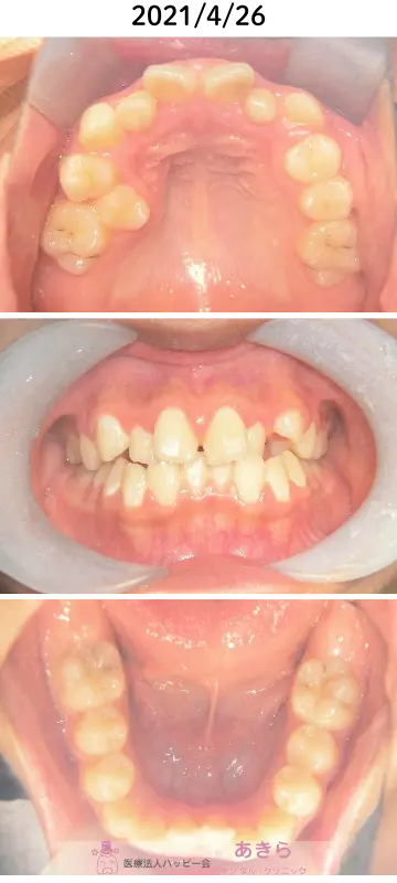 2021年4月26日 初診時口腔内写真