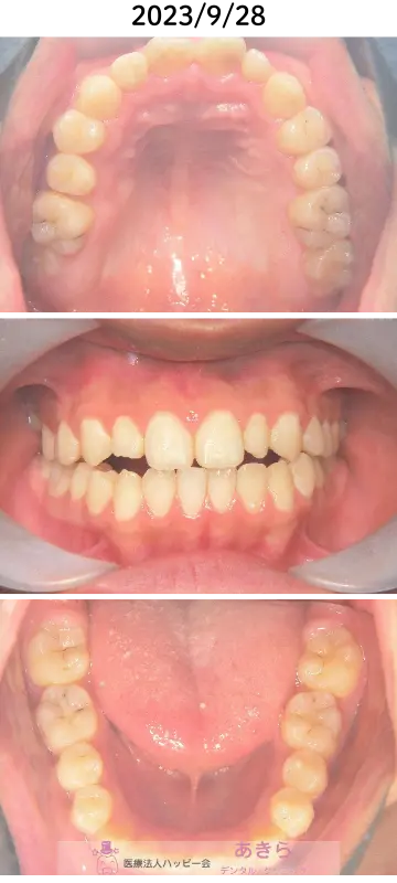 2023年9月28日 口腔内写真（経過）