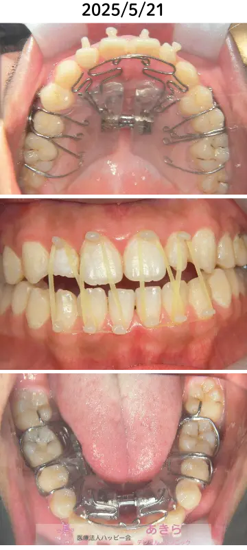 2025年5月21日 口腔内写真（顎間ゴムにて前歯部牽引）