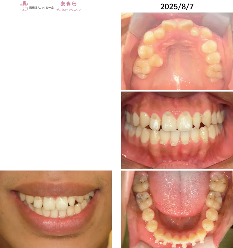 2025年8月7日 口腔内写真（顎間ゴム牽引終了～保定へ）