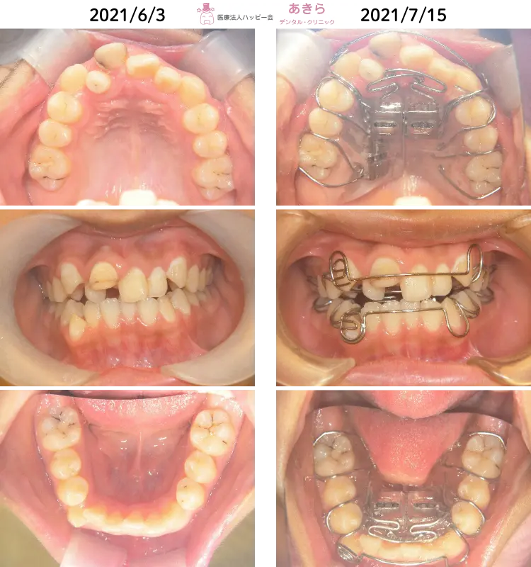 2021年6月3日　初診時 ⇒ 7月15日　SHAスタート時