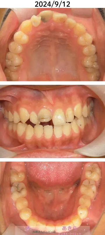 2024年9月12日　口腔内（経過）