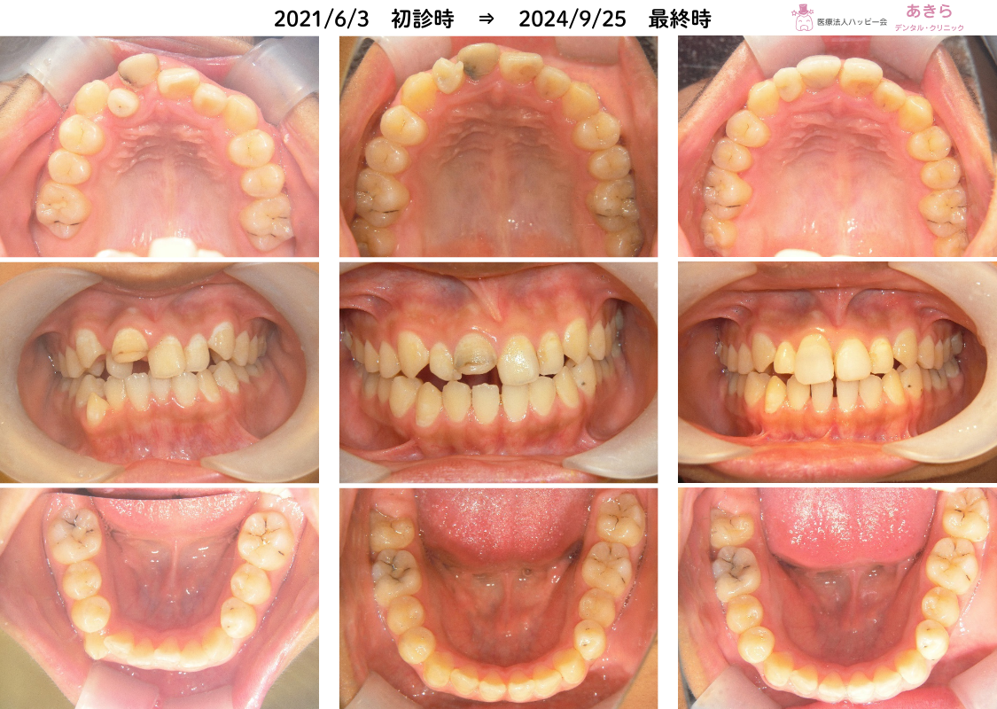 2021年6月3日　初診時 ⇒ 2024年9月25日　最終時