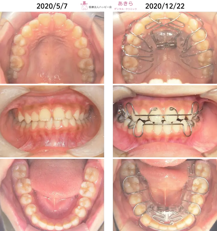 2020年5月7日 初診時 ⇒ 2020年12月22日 SHAスタート時