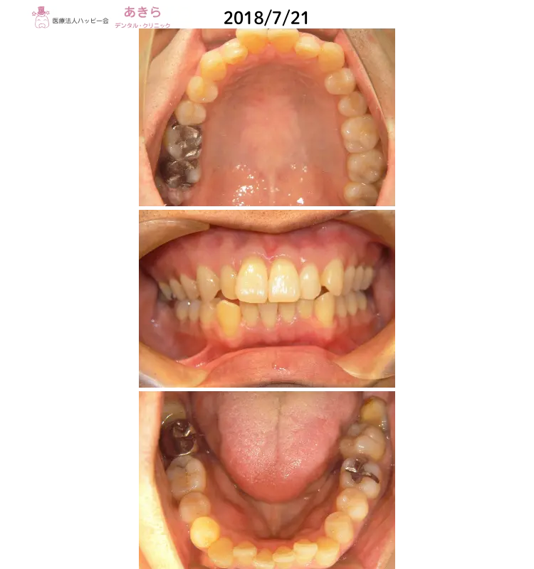 2018年7月21日初診時口腔内写真