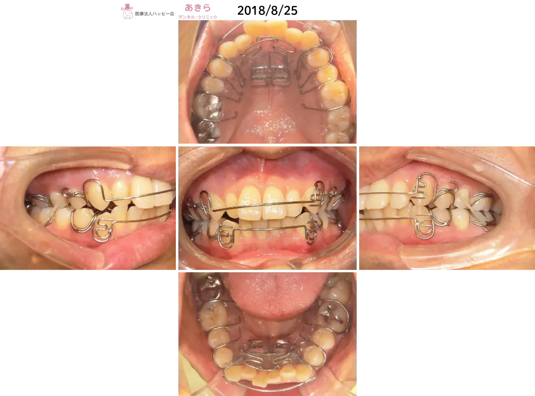2018年8月25日口腔内写真（SH装置スタート）