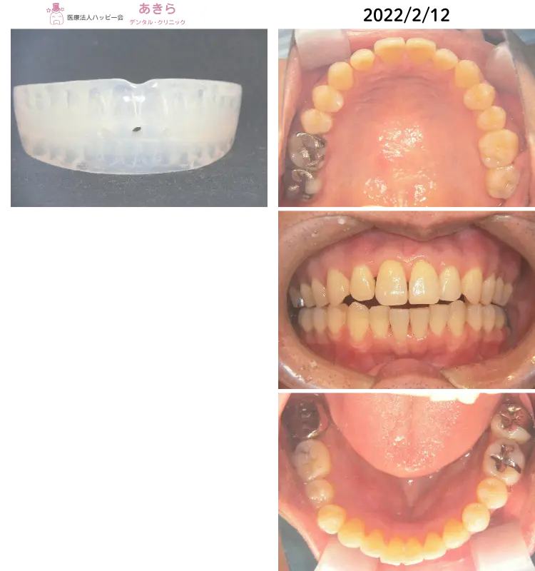 2022年2月12日口腔内写真（SHA拡大終了⇒ダイナミックポジショナー使用開始）