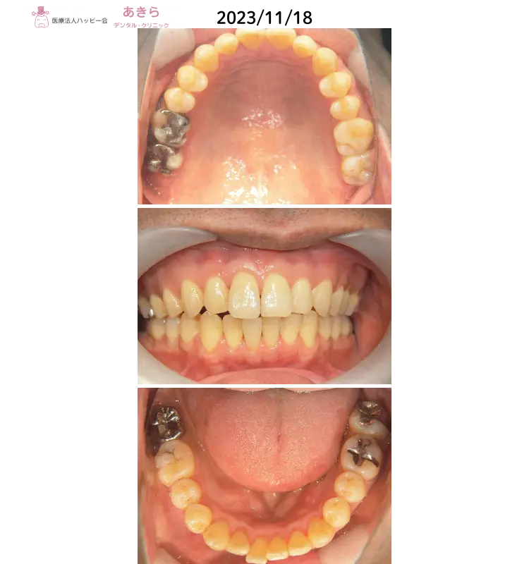 2023年11月18日　口腔内写真（最終時）