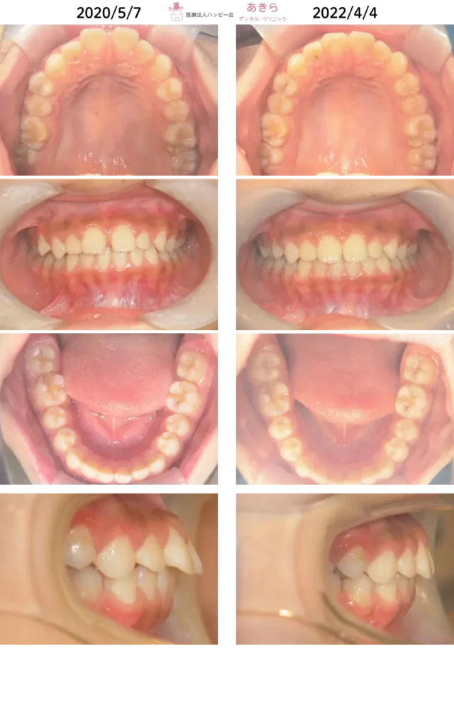 2020年5月7日 初診時 ⇒ 2022年4月4日 最終時