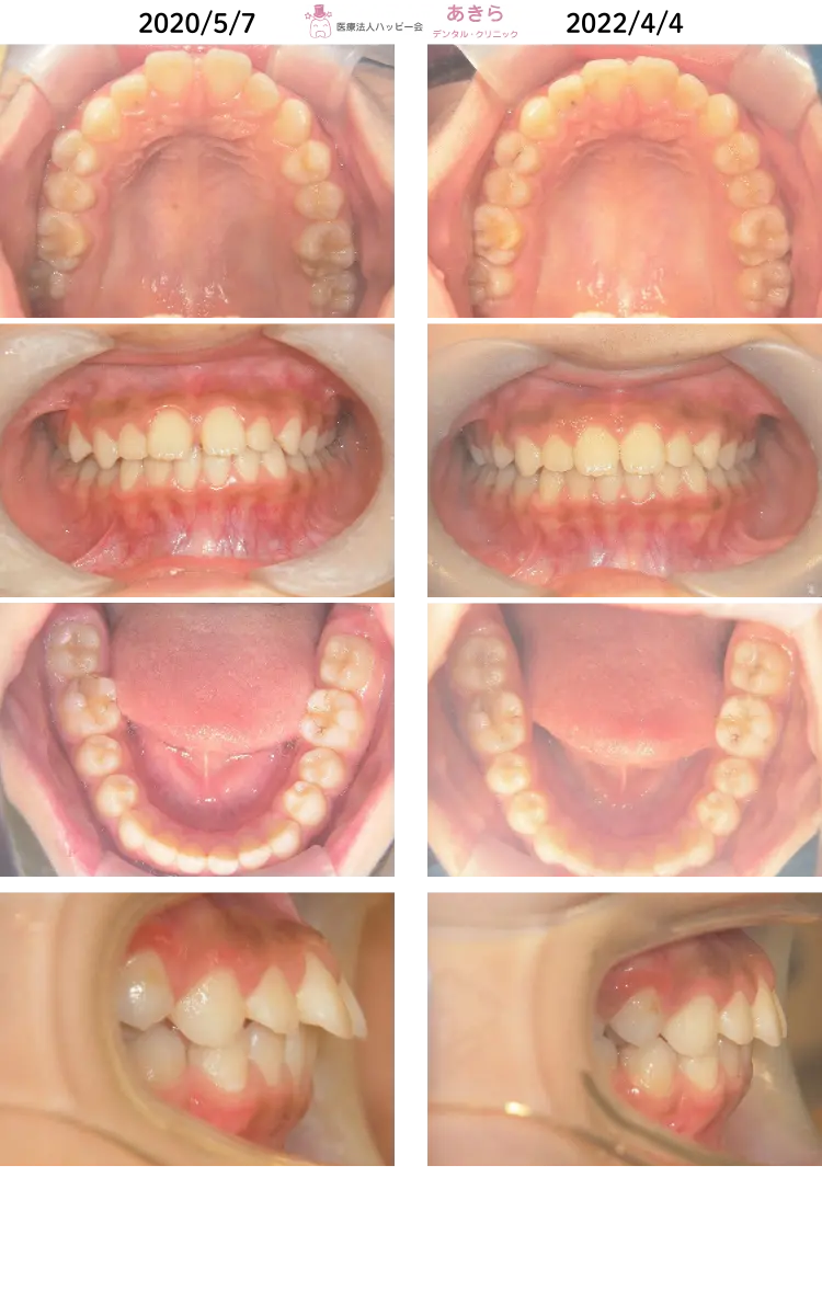 2020年5月7日 初診時 ⇒ 2022年4月4日 最終時