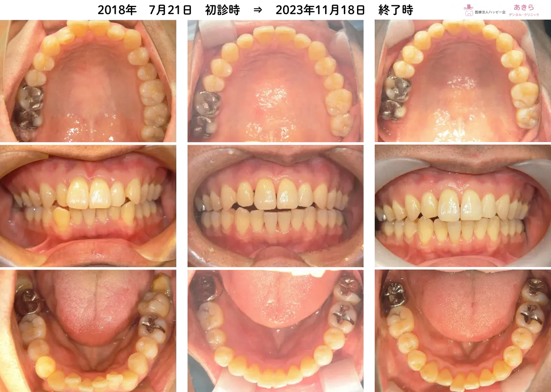 2018年7月21日初診時⇒2023年11月18日最終時