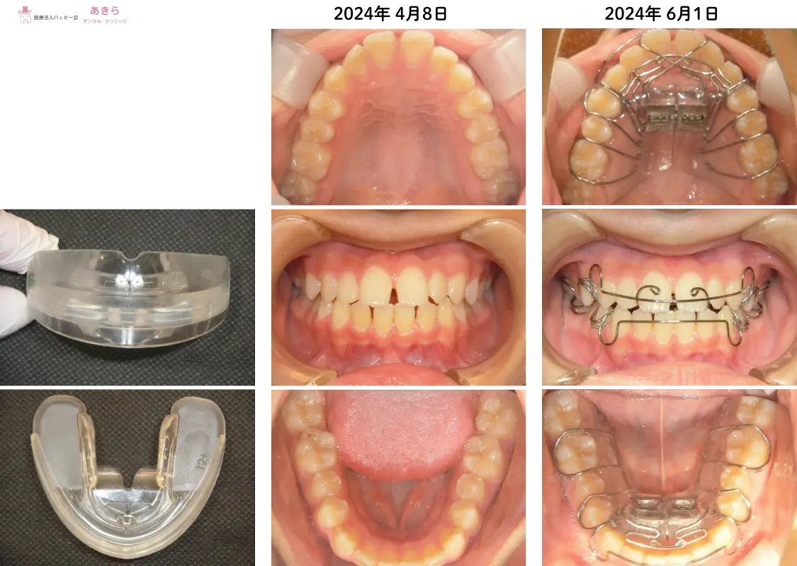 2024年4月8日　初診時
⇒2024年6月1日（SHAスタート時）