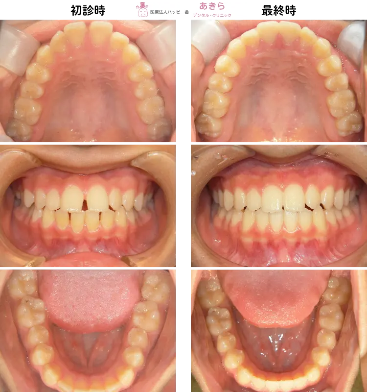 初診時⇒最終時比較　口腔内写真-001