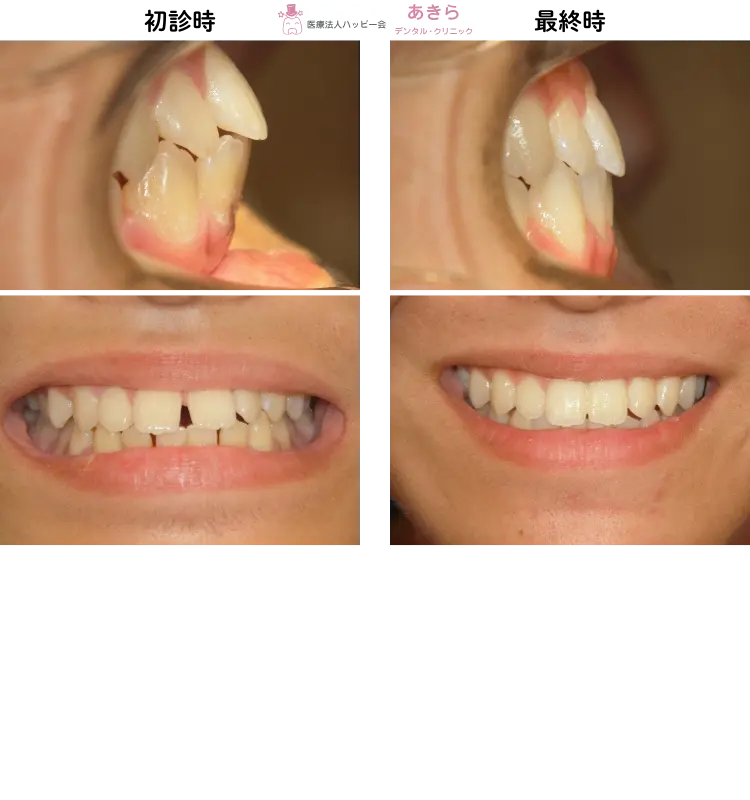 初診時⇒最終時比較　口腔内写真-002